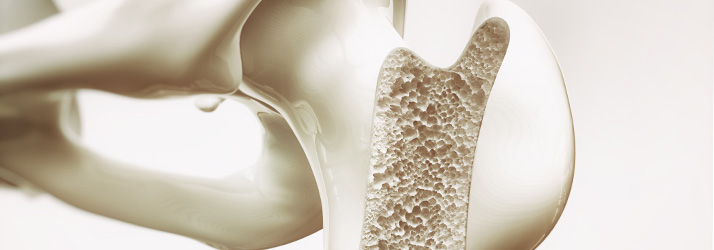Chiropractic West Bend WI Preventing Osteoporosis Chiropractic West Bend WI Preventing Osteoporosis